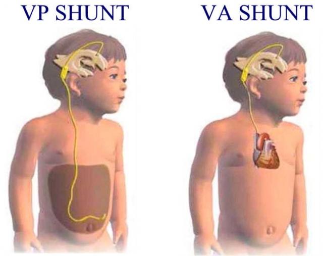 Hydrocephalus Shunts